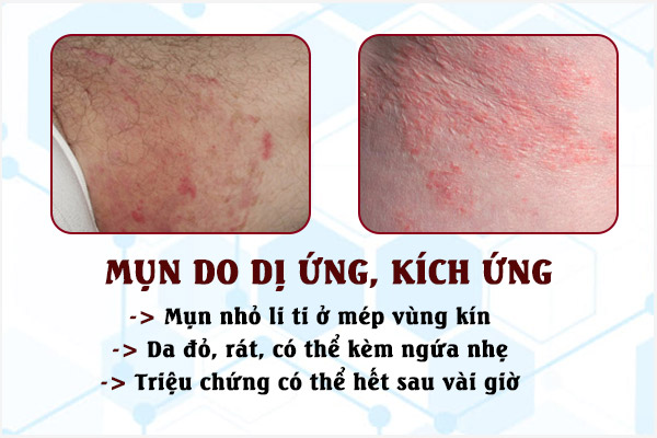 Mun-do-kich-ung