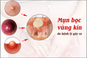 Mọc mụn bọc ở vùng kín nữ là bị gì?
